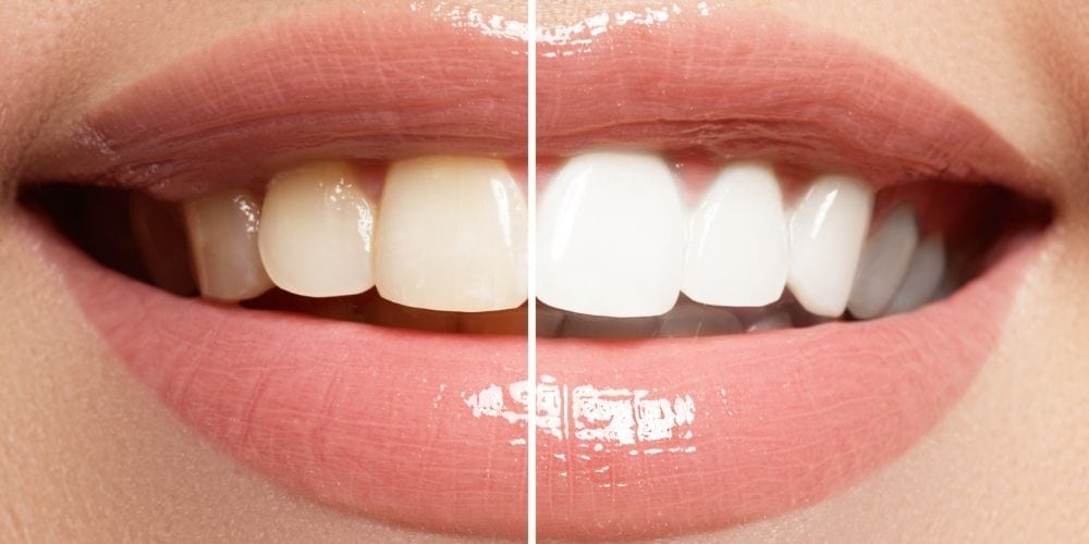 Some Tips to Keep Your Teeth White and Naturally